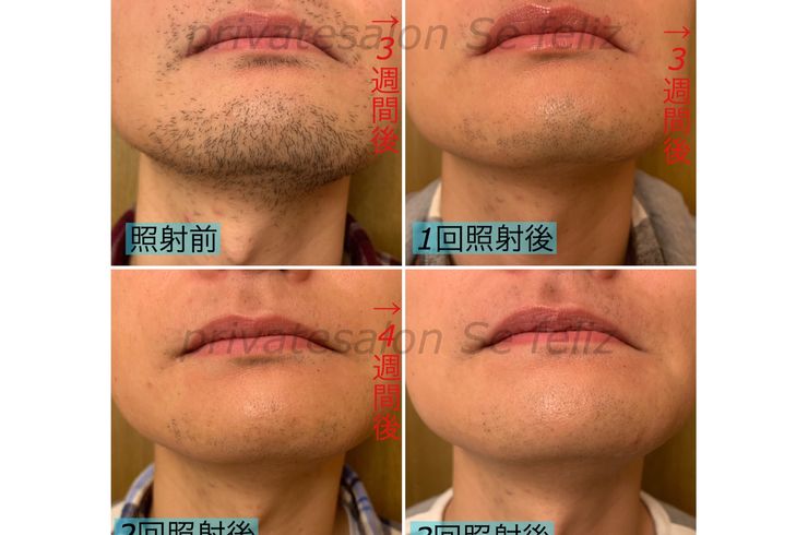 髭脱毛の効果