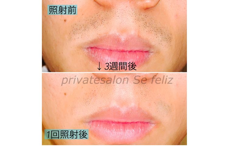 口周りの髭脱毛 小山市のエステ 脱毛 メンズ脱毛セフェリスからお届けする最新情報ブログ