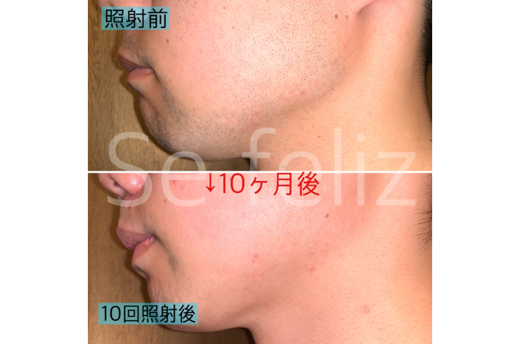 栃木メンズ脱毛