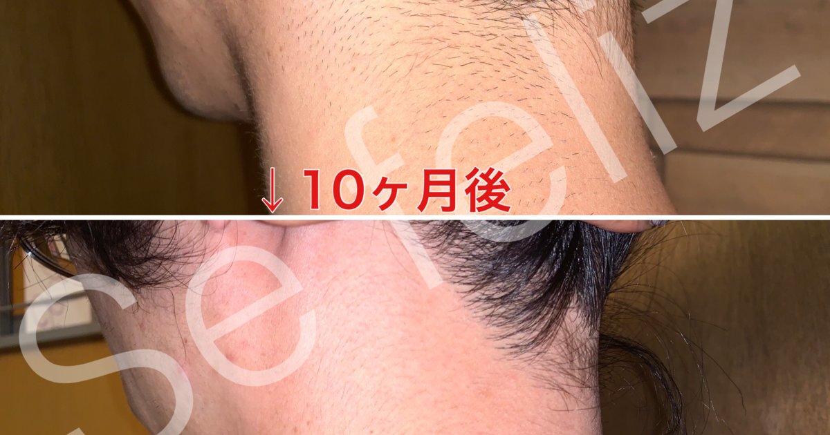夏前に 男性の襟足脱毛