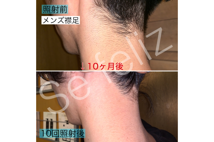 夏前に 男性の襟足脱毛
