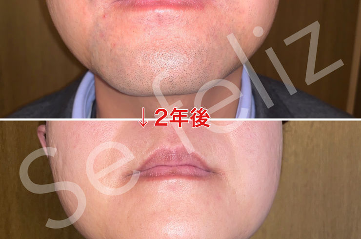 髭脱毛通い放題