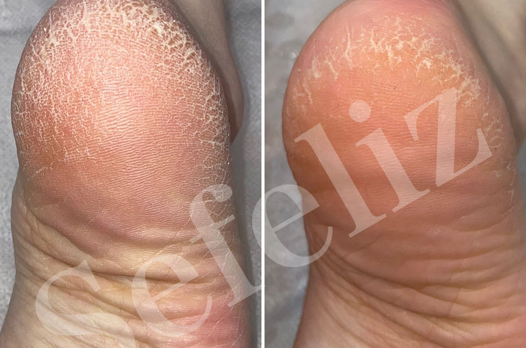 ガサガサかかと