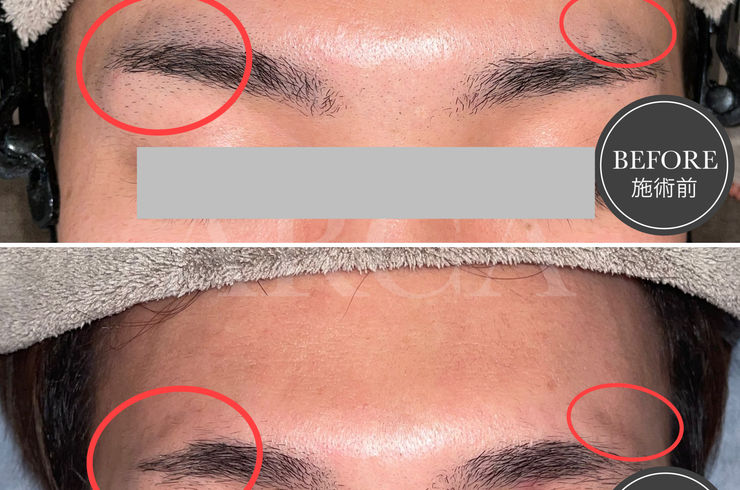 小山市眉毛脱毛