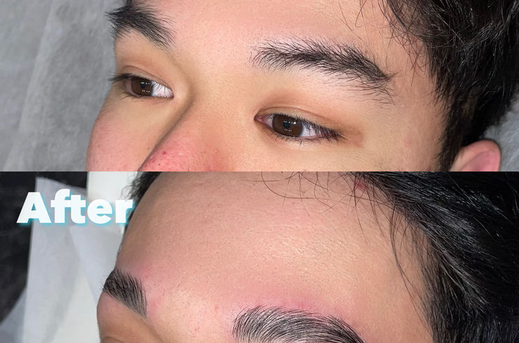 小山市ハリウッドブロウリフト