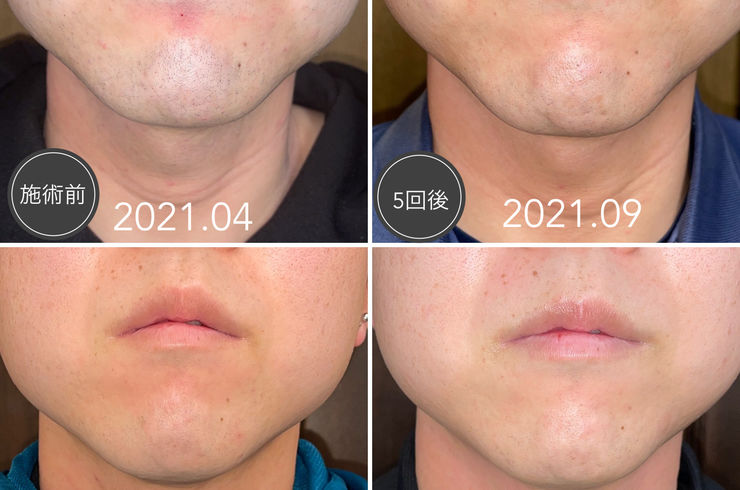 ヒゲ脱毛経過写真
