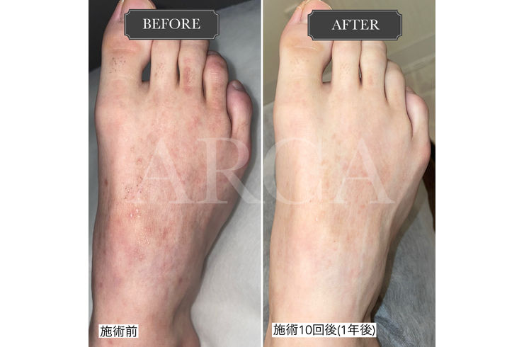 アトピー肌の脱毛