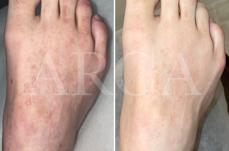 アトピー肌の脱毛