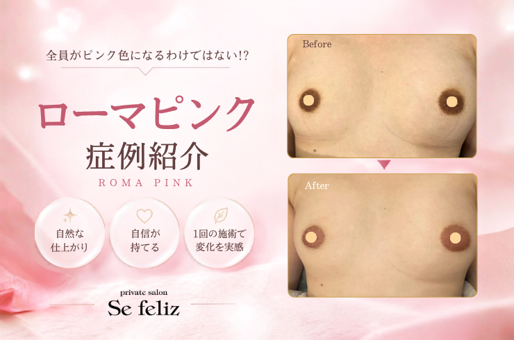 ローマピンク乳輪