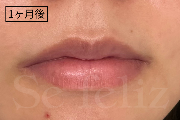 ローマピンク唇の症例紹介｜効果・施術後の経過【小山市初導入】