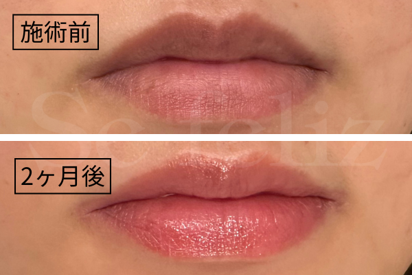 ローマピンク唇の症例紹介｜効果・施術後の経過【小山市初導入】