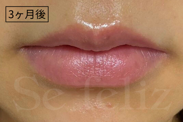 ローマピンク唇の症例紹介｜効果・施術後の経過【小山市初導入】
